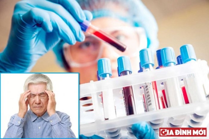 Phương pháp chẩn đoán được Alzhimer nhờ việc xét nghiệm máu