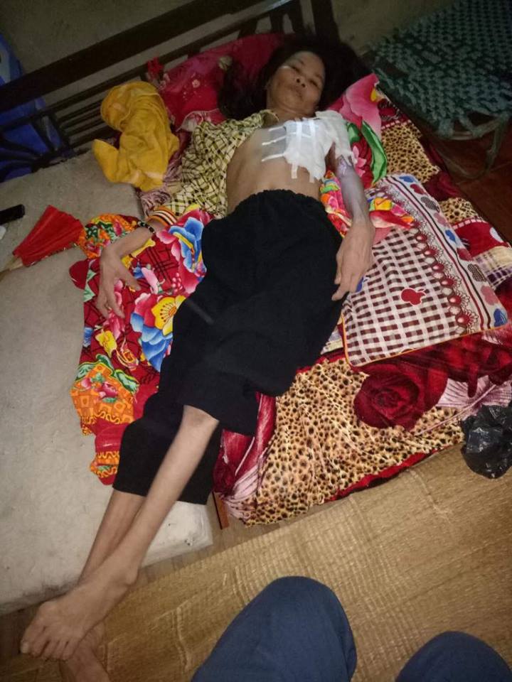 Hoàn cảnh éo le của người phụ nữ tật nguyền bị bỏng nặng