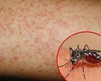 Cả nước đã ghi nhận 15 trường hợp tử vong do sốt xuất huyết 