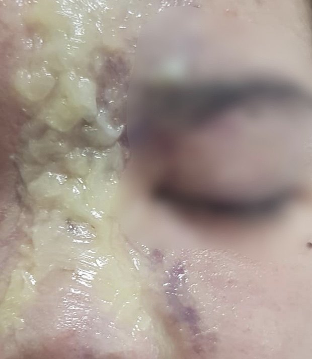 Thiếu nữ 15 tuổi mù mắt sau tiêm filler nâng mũi ở spa