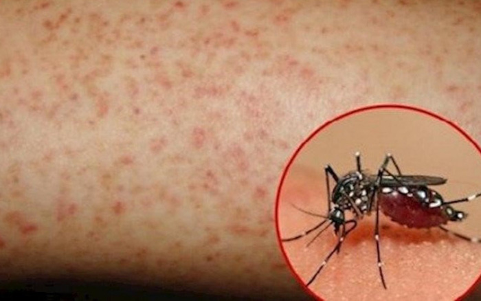 Thêm 228 ca sốt xuất huyết trong vòng 1 tuần tại Hà Nội