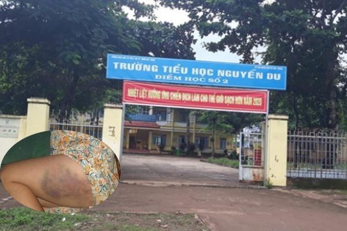  Đình chỉ 3 tháng với cô giáo đánh học sinh lớp 3 bầm tím