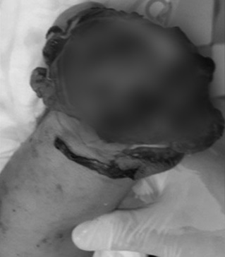 Bình gas mini phát nổ khiến người đàn ông mất bàn tay phải