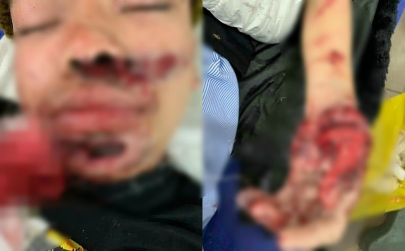 Yên Bái Điện thoại phát nổ trong khi sử dụng một người bị thương nặng