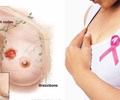 Những dấu hiệu bất thường cảnh báo ung thư vú 
