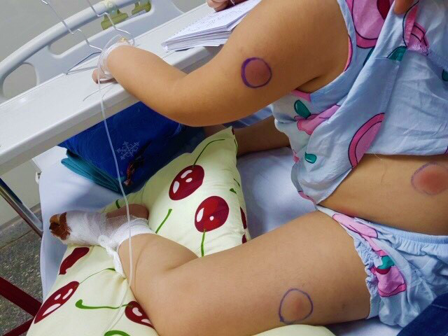 Bị gà mổ bé gái 6 tuổi nhiễm vi khuẩn ăn thịt người