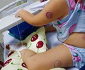 Bị gà mổ bé gái 6 tuổi nhiễm vi khuẩn ăn thịt người 