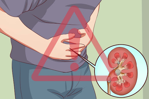 Dấu hiệu cảnh báo bạn đang bị sỏi thận