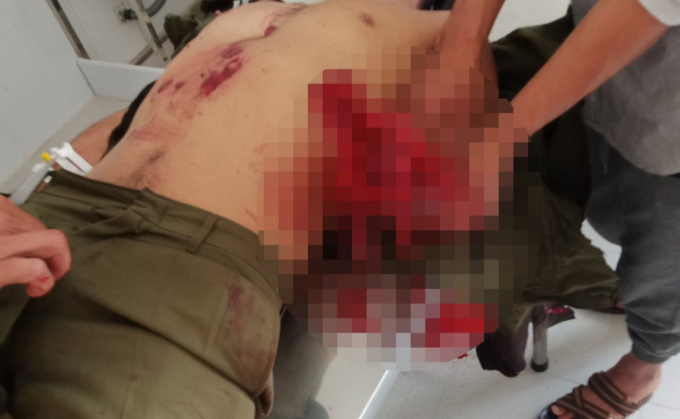 Lâm Đồng Nổ mìn đánh cá 7 người nhập viện