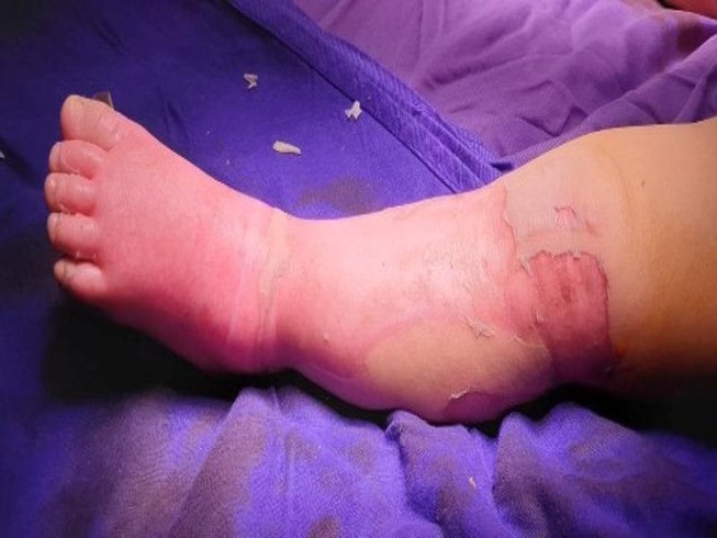 Bé trai 9 tháng tuổi tử vong do tự đắp lá chữa bỏng tại nhà