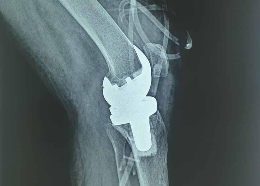 Lần đầu tiên thay thành công khớp gối nhân tạo cho bệnh nhân lao