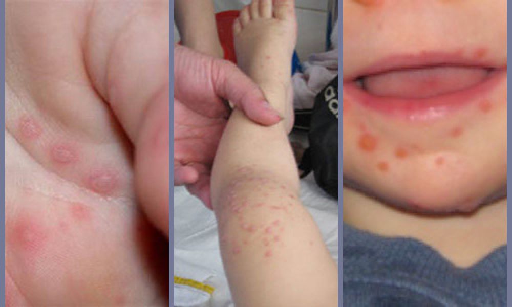 Hà Nội Bệnh tay chân miệng đã xuất hiện tại 28 quận, huyện