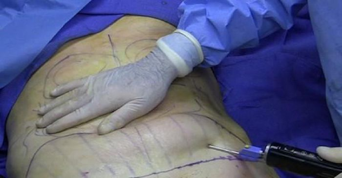 Một phụ nữ 50 tuổi ở TP HCM bị tử vong do hút mỡ bụng tại Bệnh viện Thẩm mỹ GANG WHOO