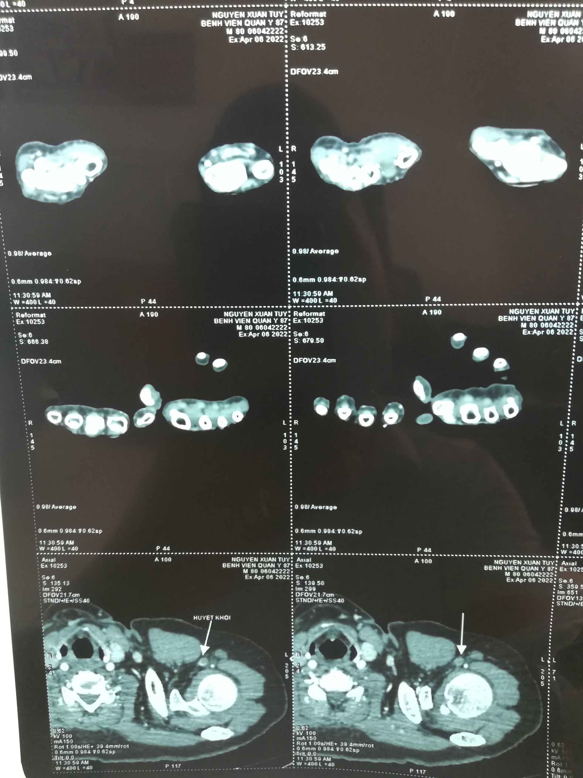 Cụ ông 80 tuổi bị tắc động mạch cánh tay trái do huyết khối được cứu sống kịp thời