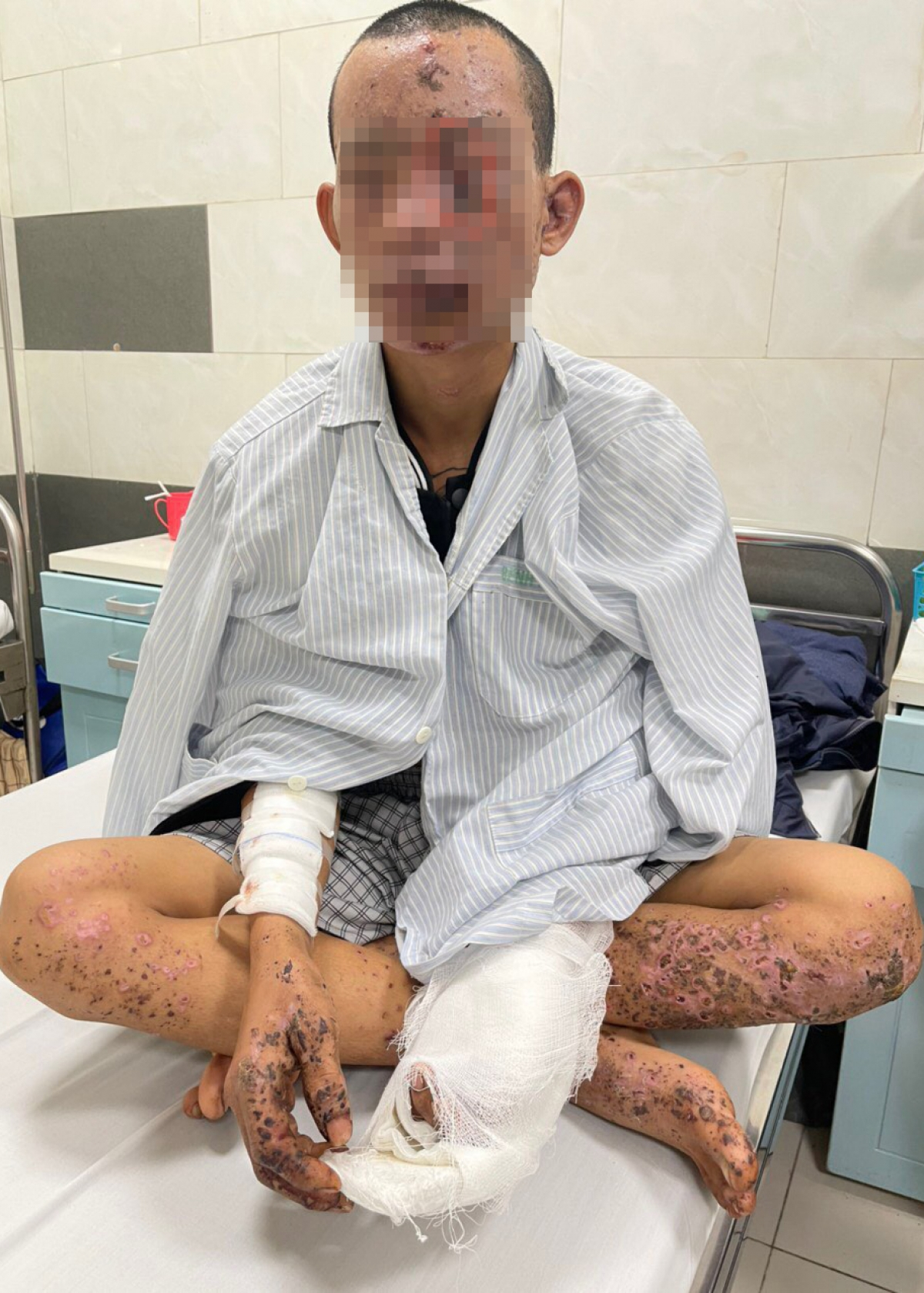 Nam thanh niên bị cháy sém toàn thân, có nguy cơ mù loà do dùng điện thoại khi đang sạc pin