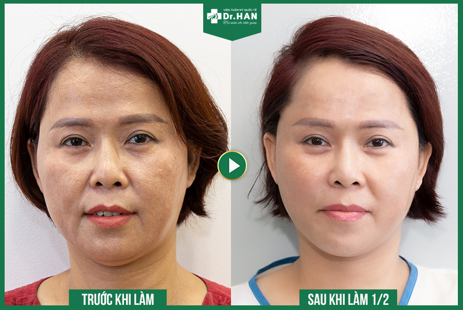 Giải pháp vàng nâng cơ trẻ hóa bằng chỉ không tiêu Hoa Kỳ
