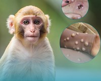 Nóng Bộ Y tế ban hành hướng dẫn chẩn đoán điều trị và phòng bệnh đậu mùa khỉ ở người