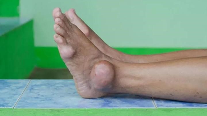 3 cách chữa bệnh gút kinh điển và giải pháp từ Hoàng Thống Phong