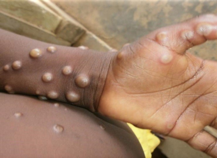 Giám sát bệnh đậu mùa khỉ ngay từ cửa khẩu, chủ động trước các tình huống dịch