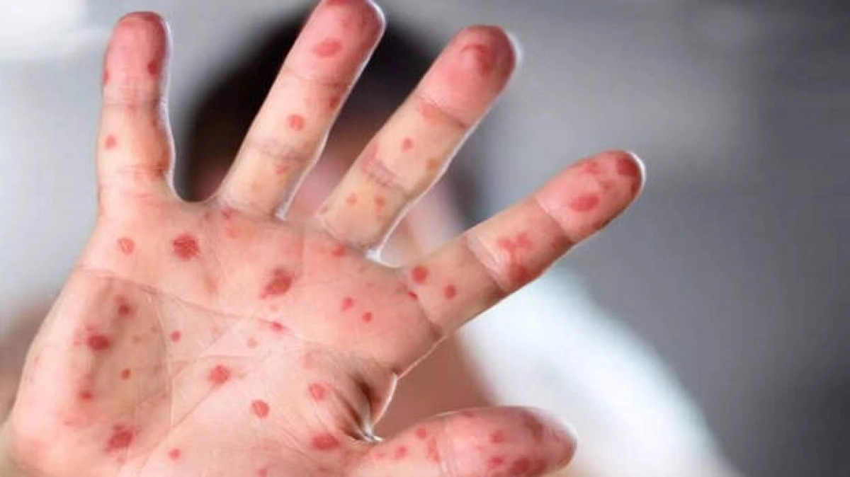 WHO Đột biến gen của virus đậu mùa khỉ có thể làm trầm trọng thêm sự lây truyền