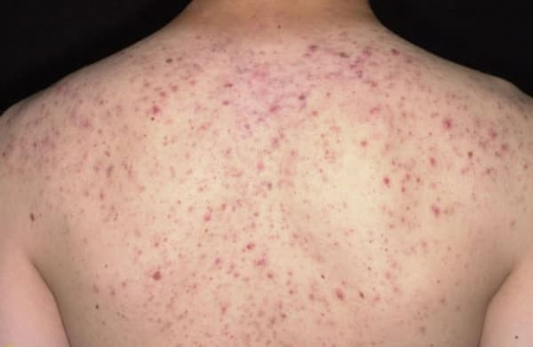 Nữ bệnh nhân 36 tuổi suýt tử vong khi trị mụn lưng tại cơ sở Spa