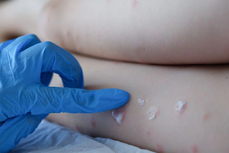 4 giai đoạn diễn biến của bệnh đậu mùa khỉ ở người