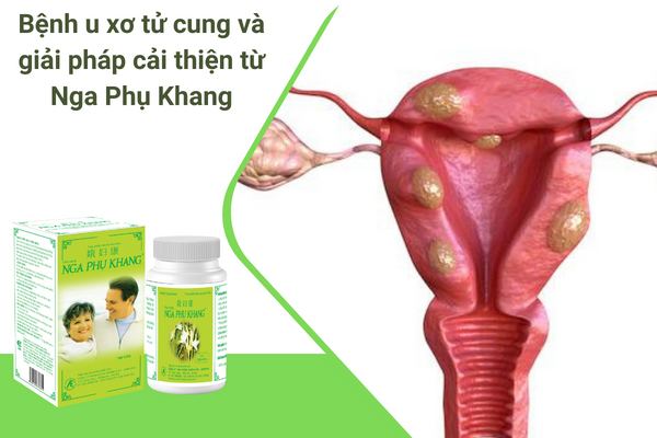 Bệnh u xơ tử cung và giải pháp cải thiện từ Nga Phụ Khang