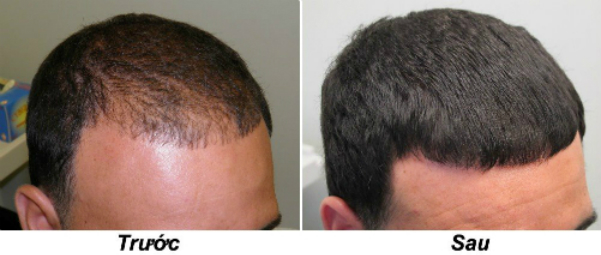 5-cach-chong-rung-va-giup-toc-moc-lai-o-nam-gioi-1