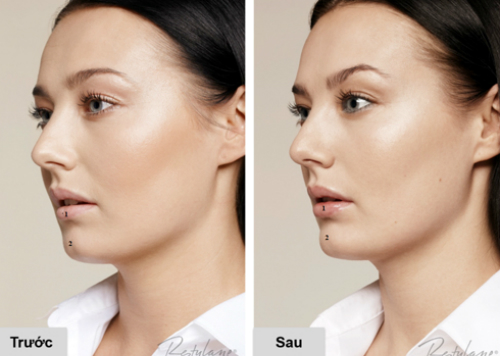 nang-niu-ve-dep-tu-nhien-cung-lieu-phap-tiem-restylane-1