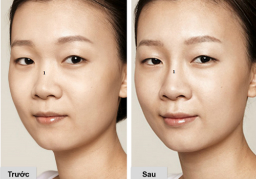 Nâng niu vẻ đẹp tự nhiên cùng liệu pháp tiêm Restylane