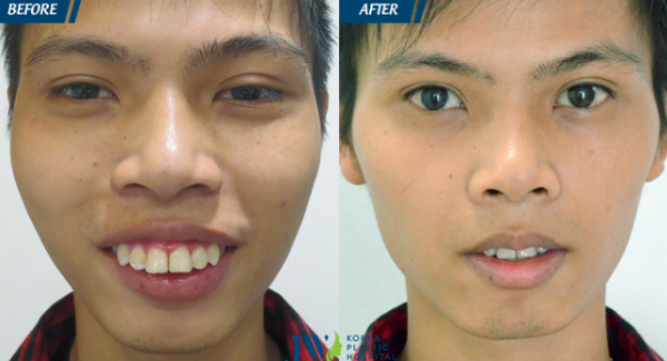 tre-hoa-khuon-mat-cho-chang-trai-gia-hon-tuoi-vi-ho-hai-ham-xin-bai-edit-2