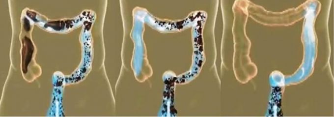 (ruột già được làm sạch khi dùng colon detox)