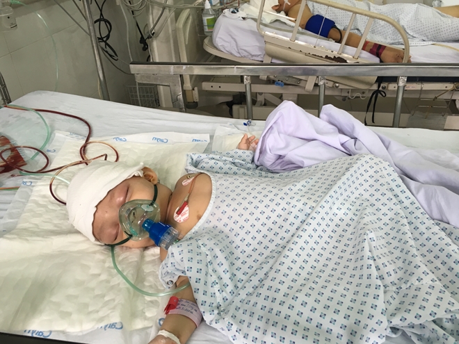 Lần đầu tiên phẫu thuật thành công em bé bị dị dạng hộp sọ hiếm gặp