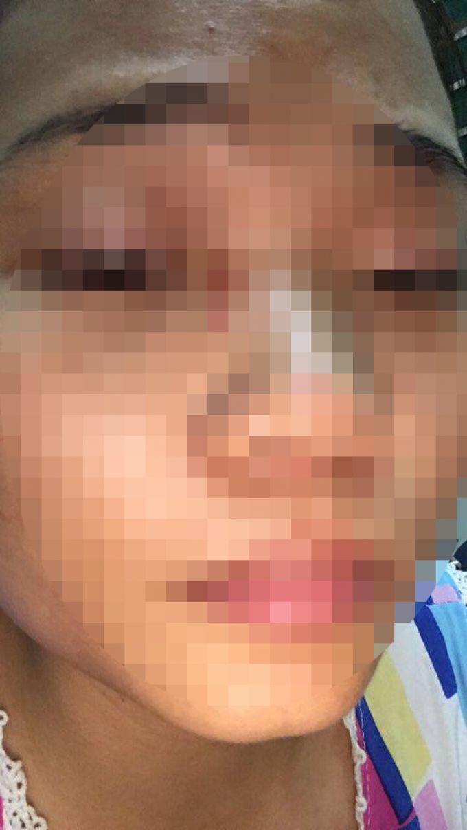 Chị H. biết bị trầy xước ở mặt, chân, lưng hơi sưng và đau. (Ảnh do nhân vật cung cấp).