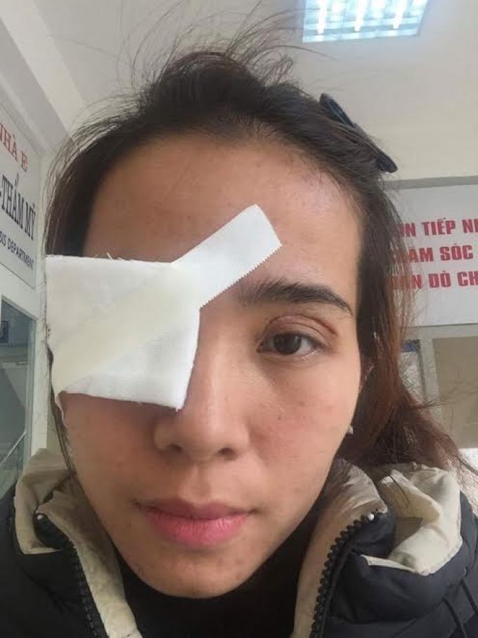 Chị Nguyễn Thị Lâm với một bên mắt bị biến chứng.