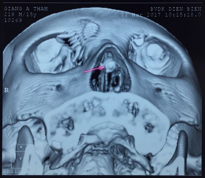 Vị trí của viên đạn.