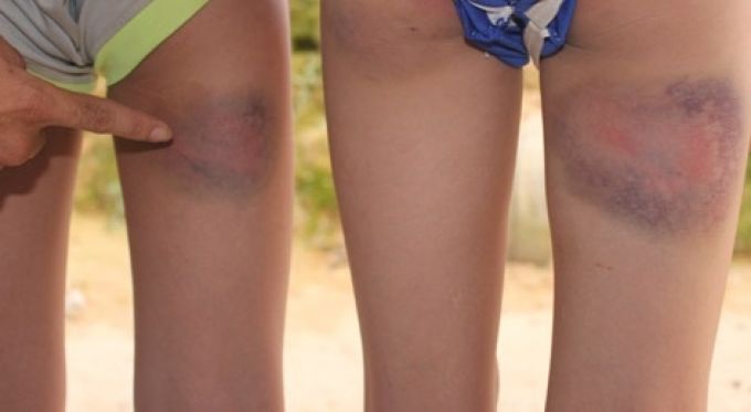 Hình ảnh những vết thương của các em học sinh do bị thầy H đánh