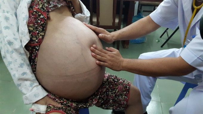 Phẫu thuật thành công loại bỏ khối u buồng trứng lớn nhất từ trước đến nay