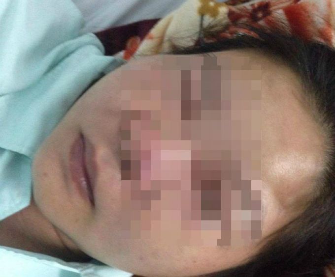 Cô gái suýt chết vì nặn mụn ở mũi