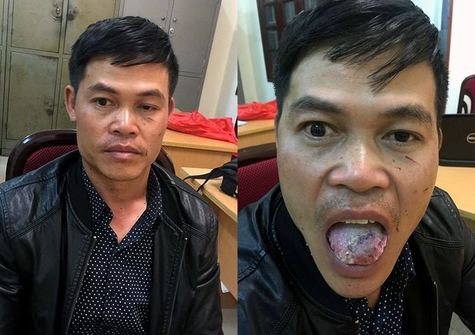 Hà Nội Bị cắn gần đứt lưỡi, yêu râu xanh vẫn quyết hiếp dâm thiếu nữ